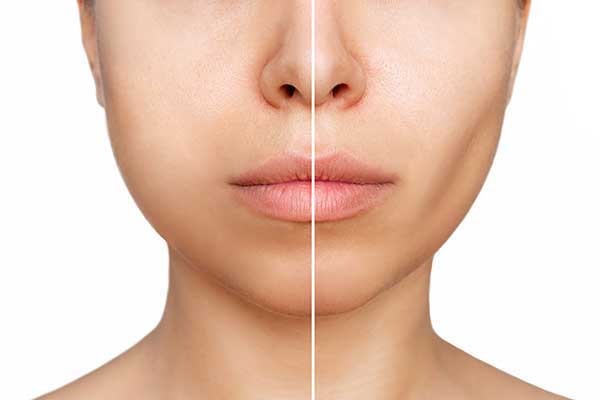 Understanding the Challenges Regarding Post-Weight Loss Surgery and Ozempic Face