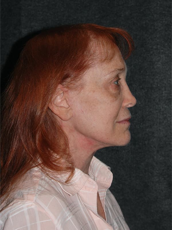 Blepharoplasty Before & After Image