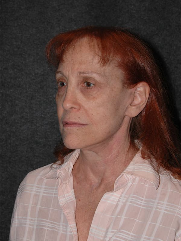 Blepharoplasty Before & After Image