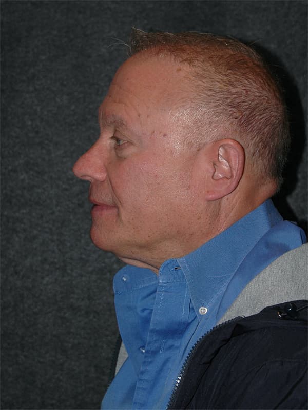 Blepharoplasty Before & After Image