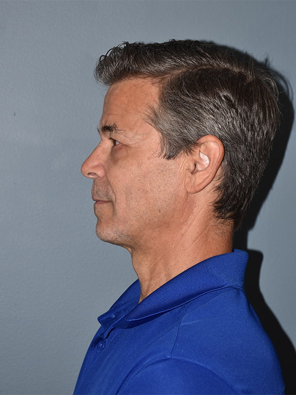 Blepharoplasty Before & After Image