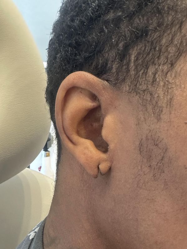 Earlobe Repair Before & After Image