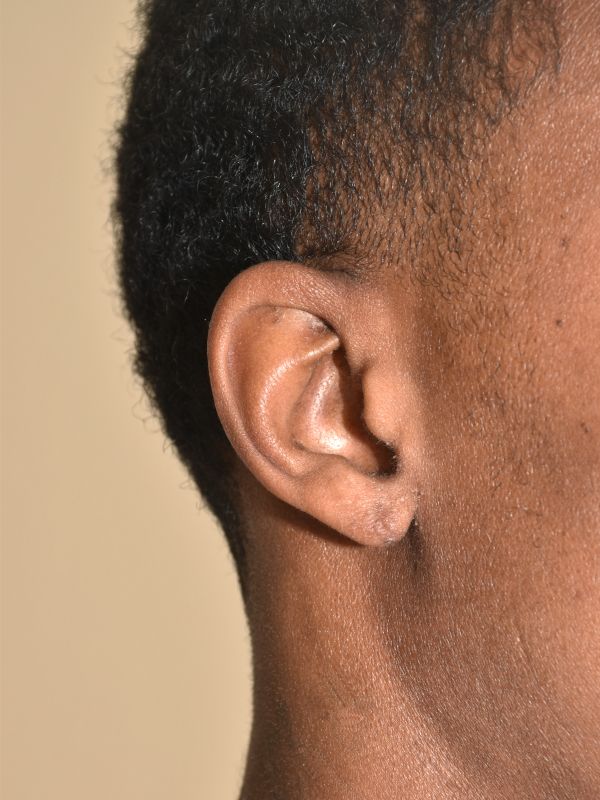 Earlobe Repair Before & After Image
