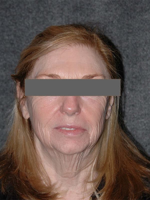 Facelift Before & After Image