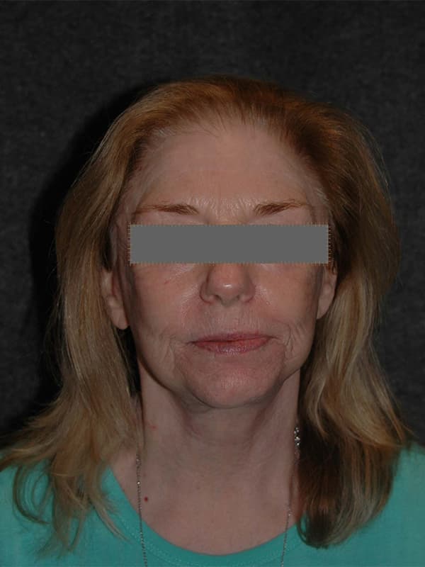 Facelift Before & After Image