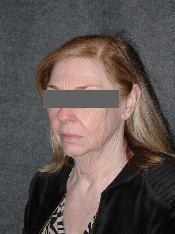 Facelift Before & After Image