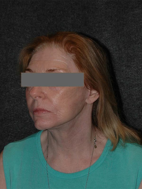 Facelift Before & After Image