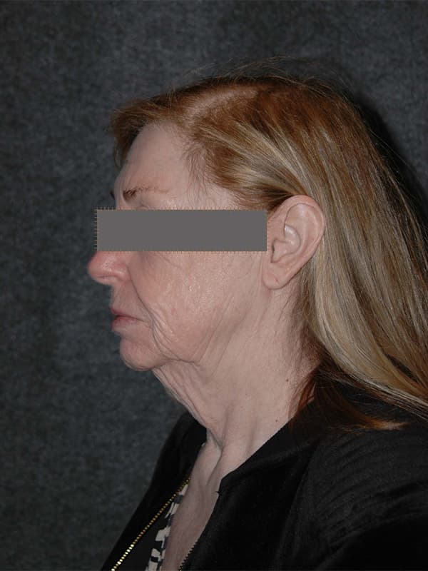 Facelift Before & After Image