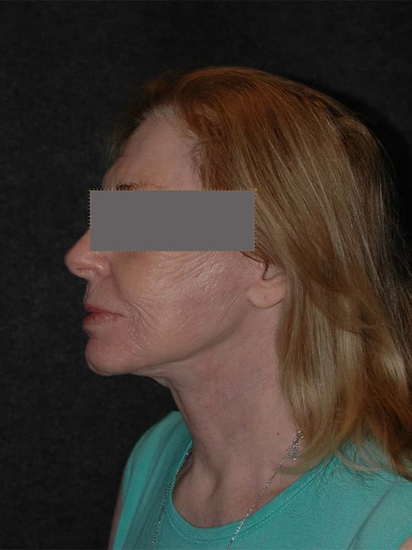 Facelift Before & After Image