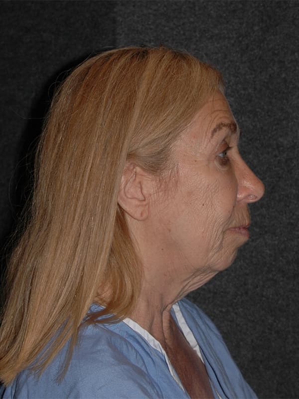 Facelift Before & After Image