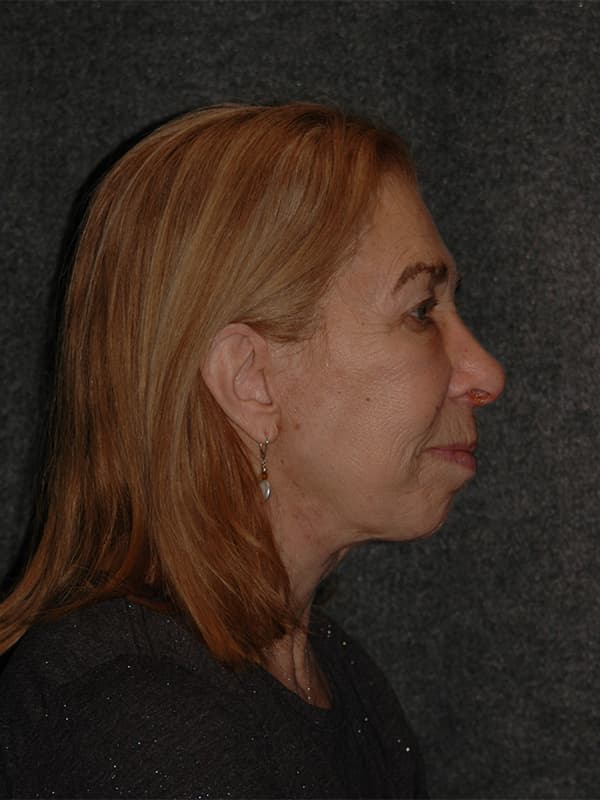 Facelift Before & After Image