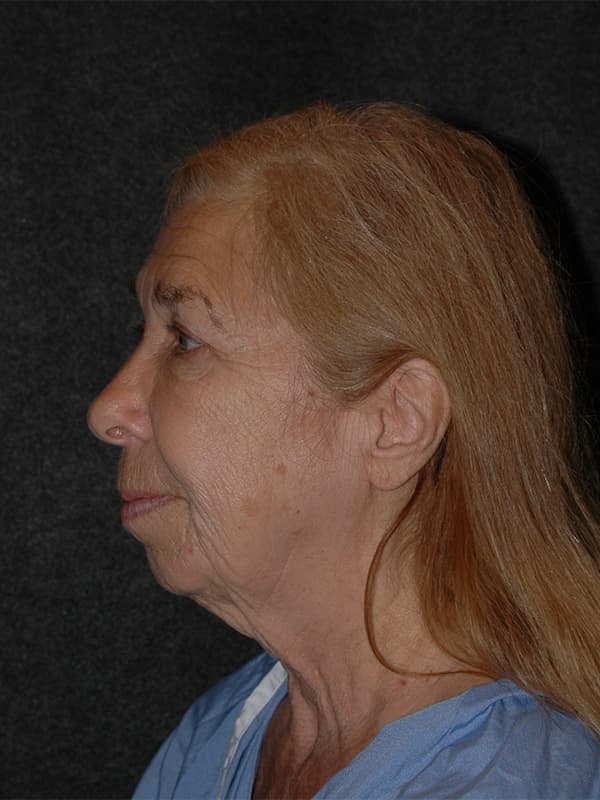 Facelift Before & After Image