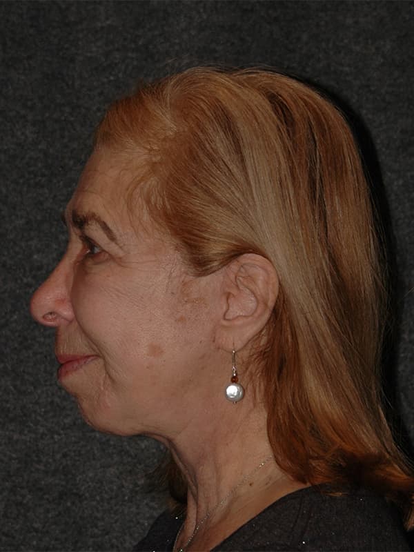 Facelift Before & After Image