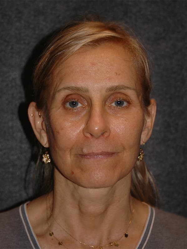 Facelift Before & After Image