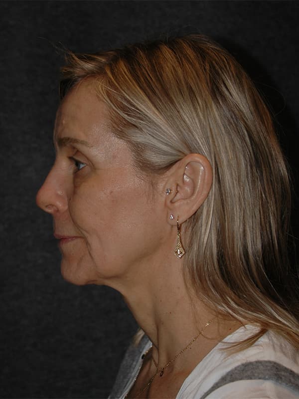 Facelift Before & After Image