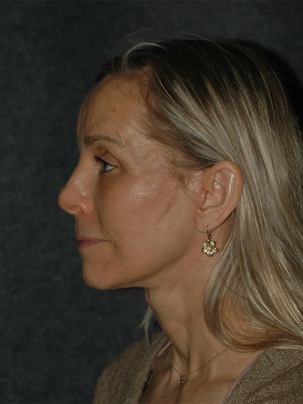 Facelift Before & After Image