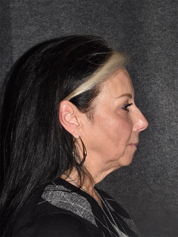 Facelift Before & After Image