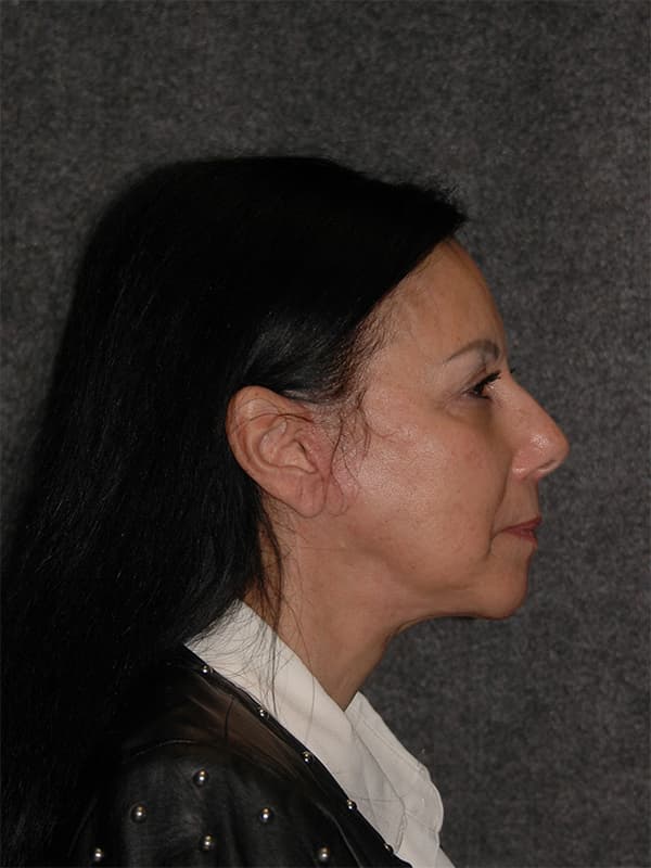 Facelift Before & After Image