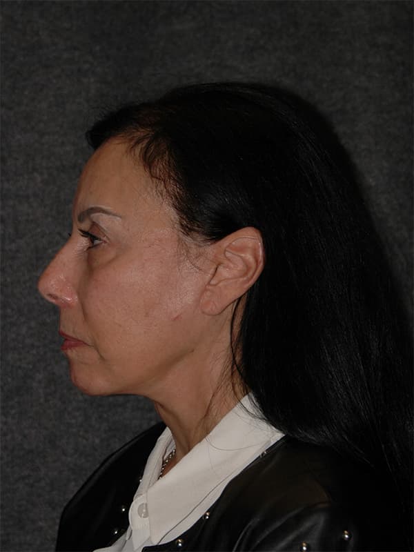 Facelift Before & After Image