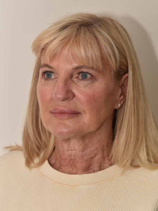 Facelift Before & After Image