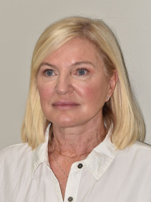 Facelift Before & After Image