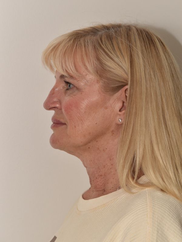 Facelift Before & After Image
