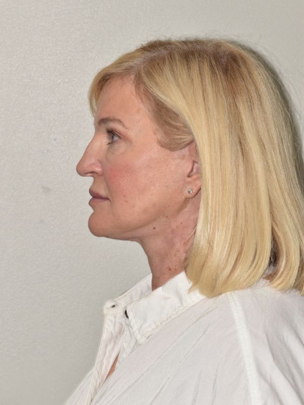 Facelift Before & After Image