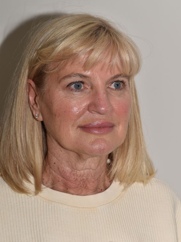 Facelift Before & After Image