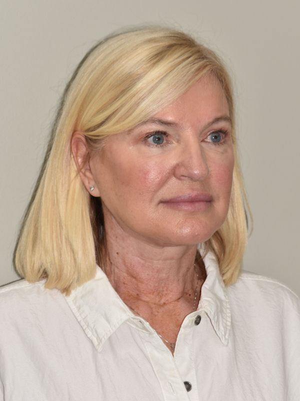 Facelift Before & After Image