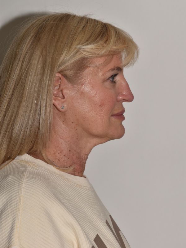 Facelift Before & After Image