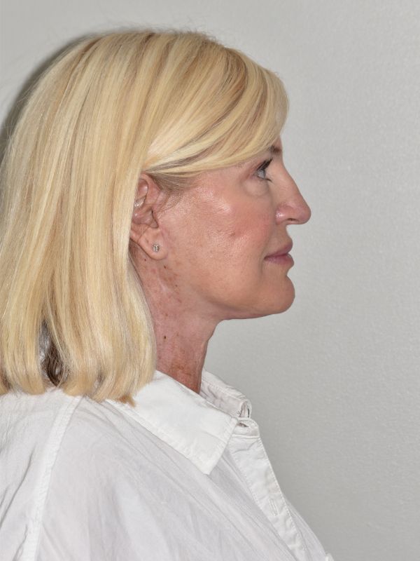 Facelift Before & After Image