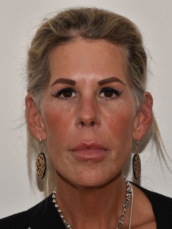 Facelift Before & After Image