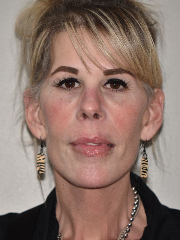 Facelift Before & After Image