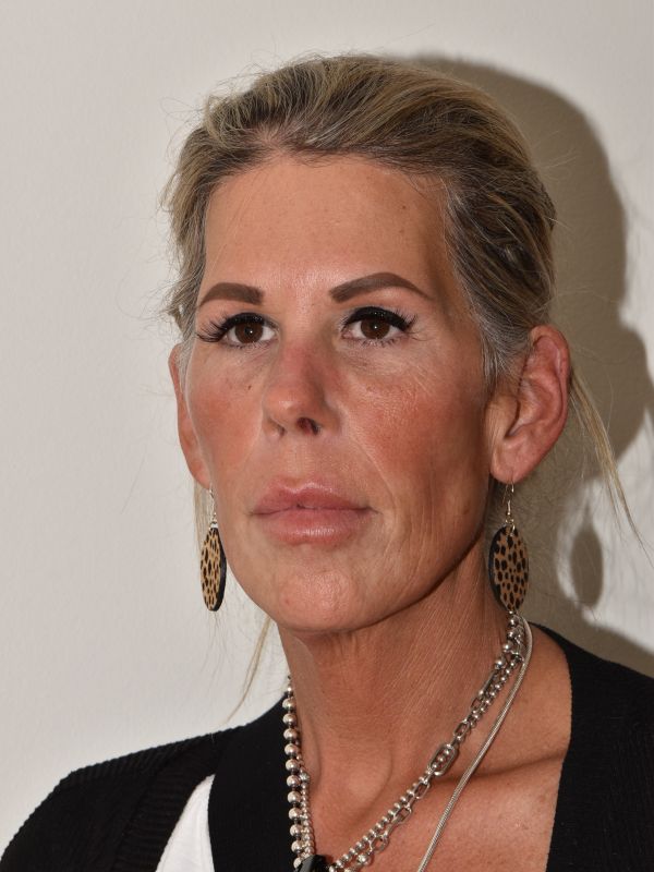 Facelift Before & After Image