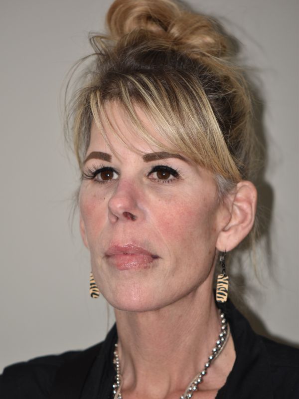 Facelift Before & After Image
