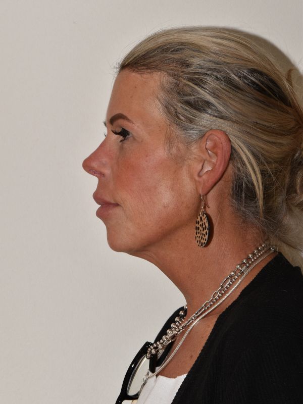 Facelift Before & After Image