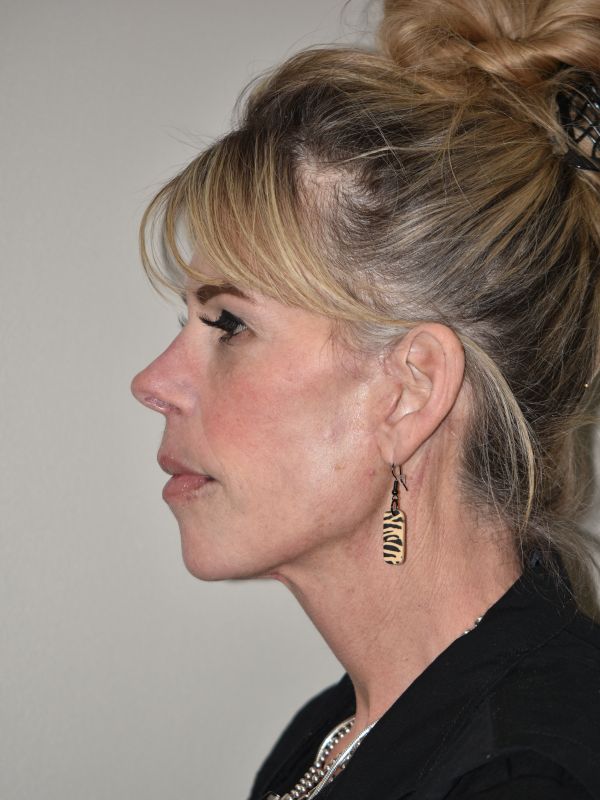 Facelift Before & After Image