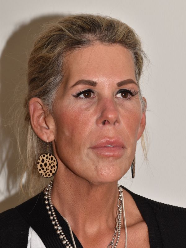 Facelift Before & After Image