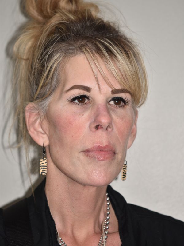 Facelift Before & After Image