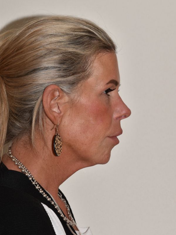 Facelift Before & After Image