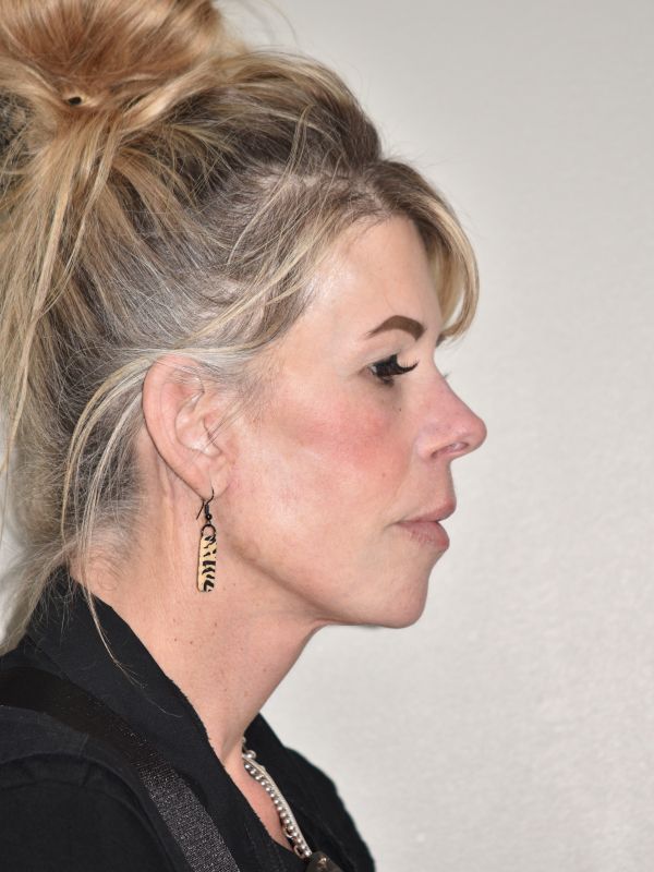 Facelift Before & After Image