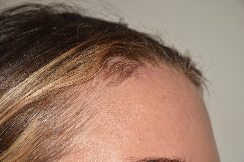 Forehead Reduction Before & After Image