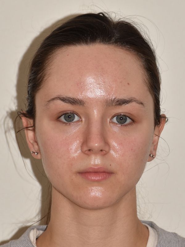 Forehead Reduction Before & After Image