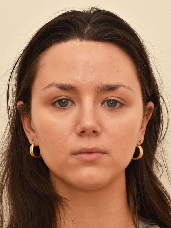 Forehead Reduction Before & After Image