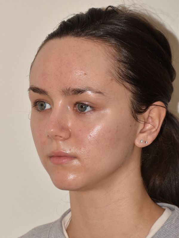 Forehead Reduction Before & After Image
