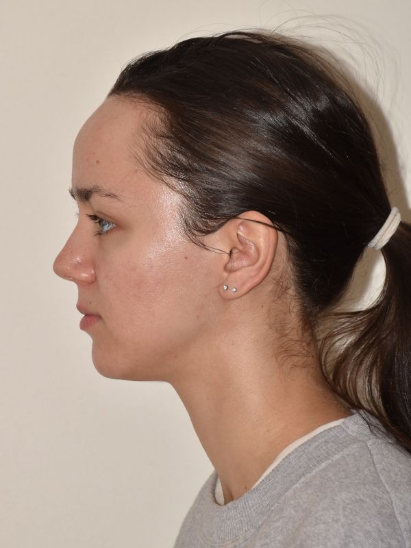 Forehead Reduction Before & After Image
