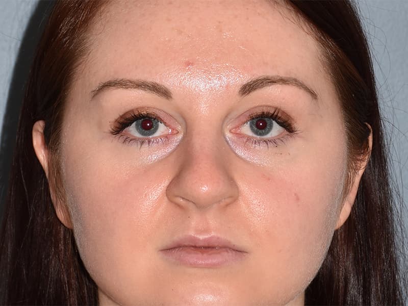 Rhinoplasty Before & After Image