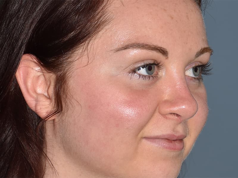 Rhinoplasty Before & After Image