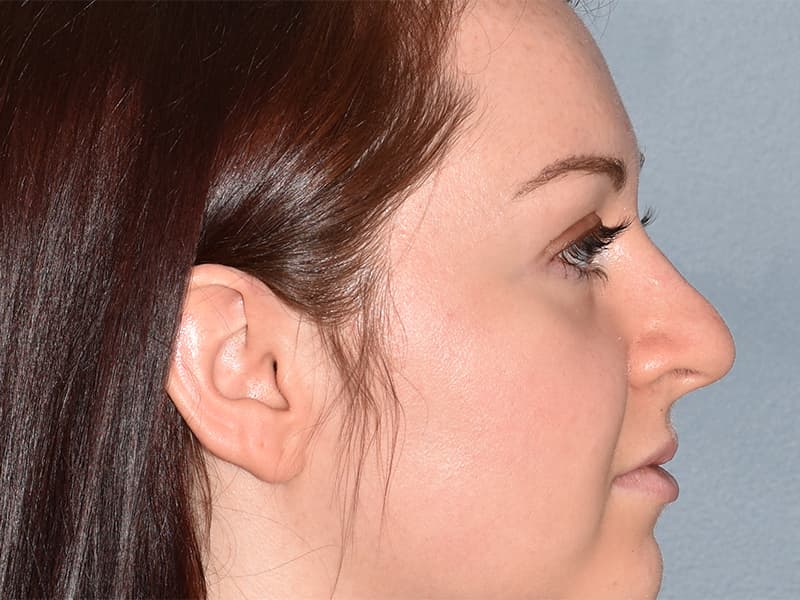 Rhinoplasty Before & After Image