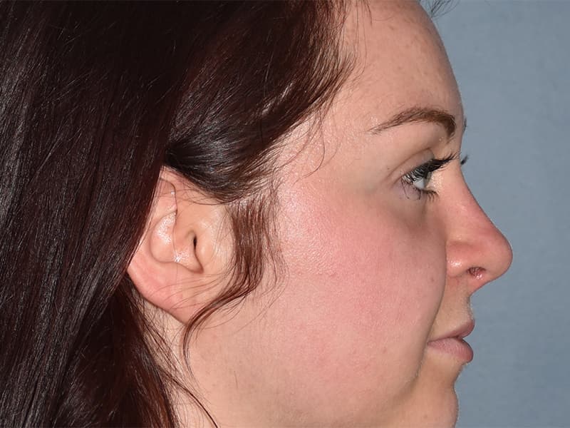 Rhinoplasty Before & After Image